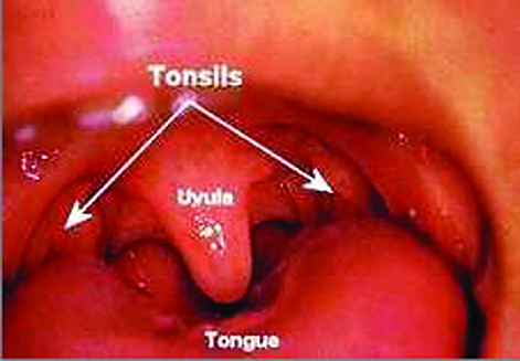 Enlarged Tonsils In Adults 113