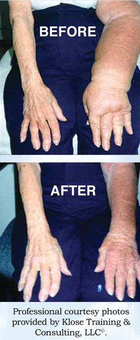 Lymphedema_arms_amj14