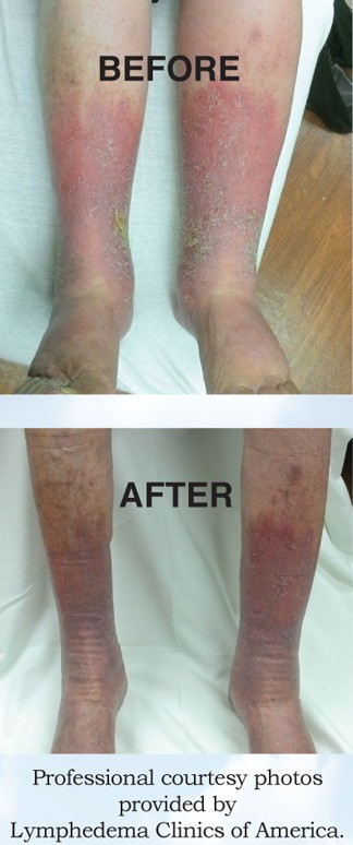 Lymphedema_pics_jas14