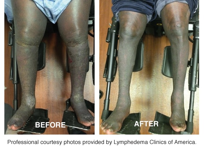 Lymphedema_pics_ond14