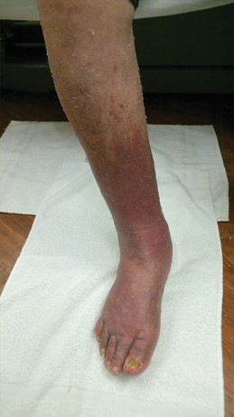 Lymphedema_Cellulitis_jfm15