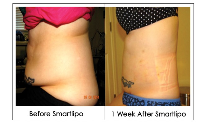 Shapira_smartlipo_jfm15_featured