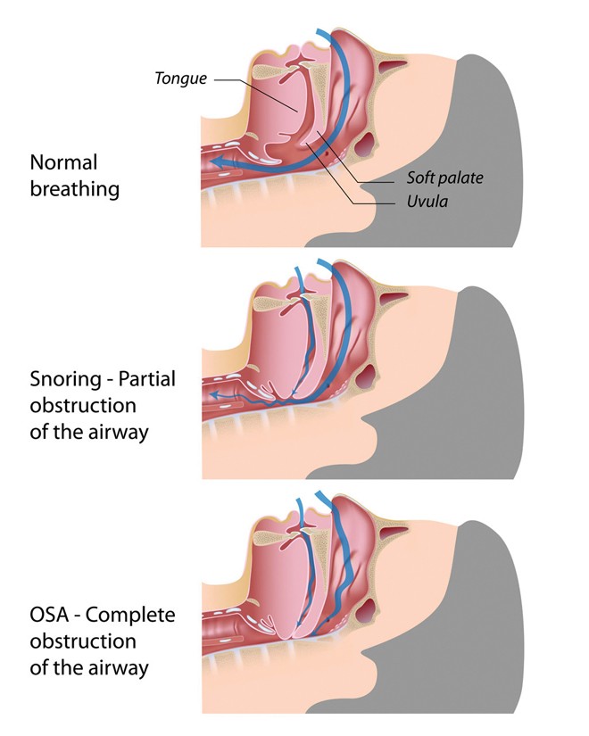 ditty_kent_fm16_obstructive-sleep-apnea