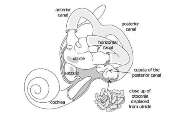 benign positional vertigo