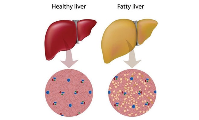 Can Weight Loss Surgery Treat Fatty Liver & Pseudotumor Cerebri? - The ...