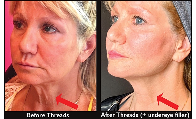 PDO Threads  Reverse aging by lifting & replenishing lost collagen