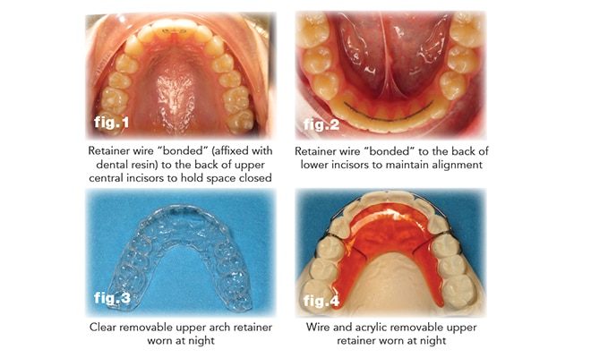 All About Orthodontic Treatment Kennett Square, PA - Greeley