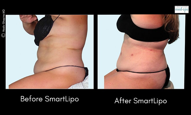 Smart Lipo - Before and After